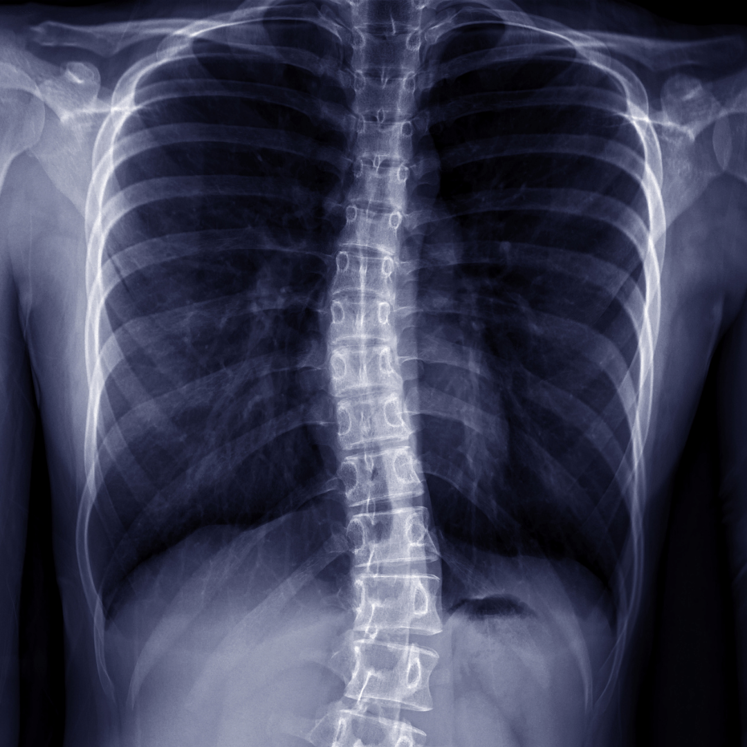 Understanding Scoliosis: Key Insights for Scoliosis